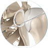 labral repair image by Dr. McCarthy